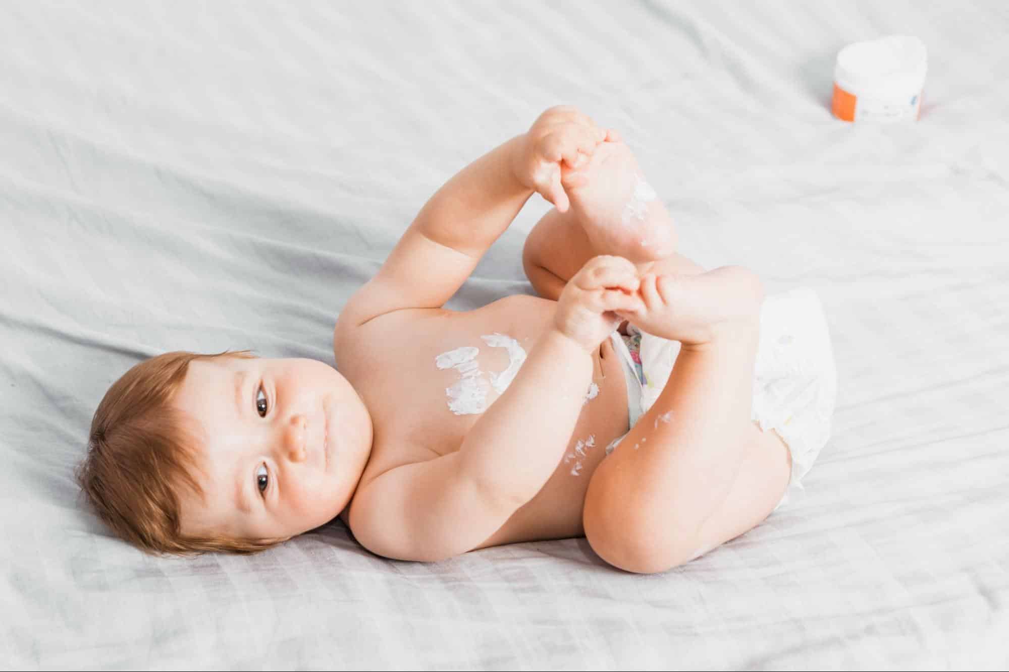Diapered baby on soft bedding with medicated cream for skin rash treatment.